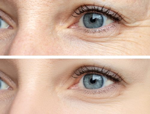 woman face, eye wrinkles before and after treatment the result of rejuvenating cosmetological procedures of biorevitalization, botox and pigment spots removal