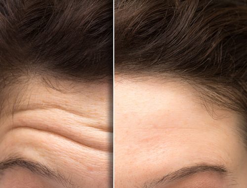 face of a woman before and after a botox treatment to smooth exp