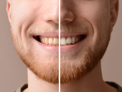 man before and after whitening of his teeth on color background
