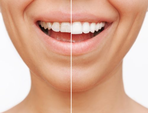 cropped shot of a young caucasian smiling woman before and after